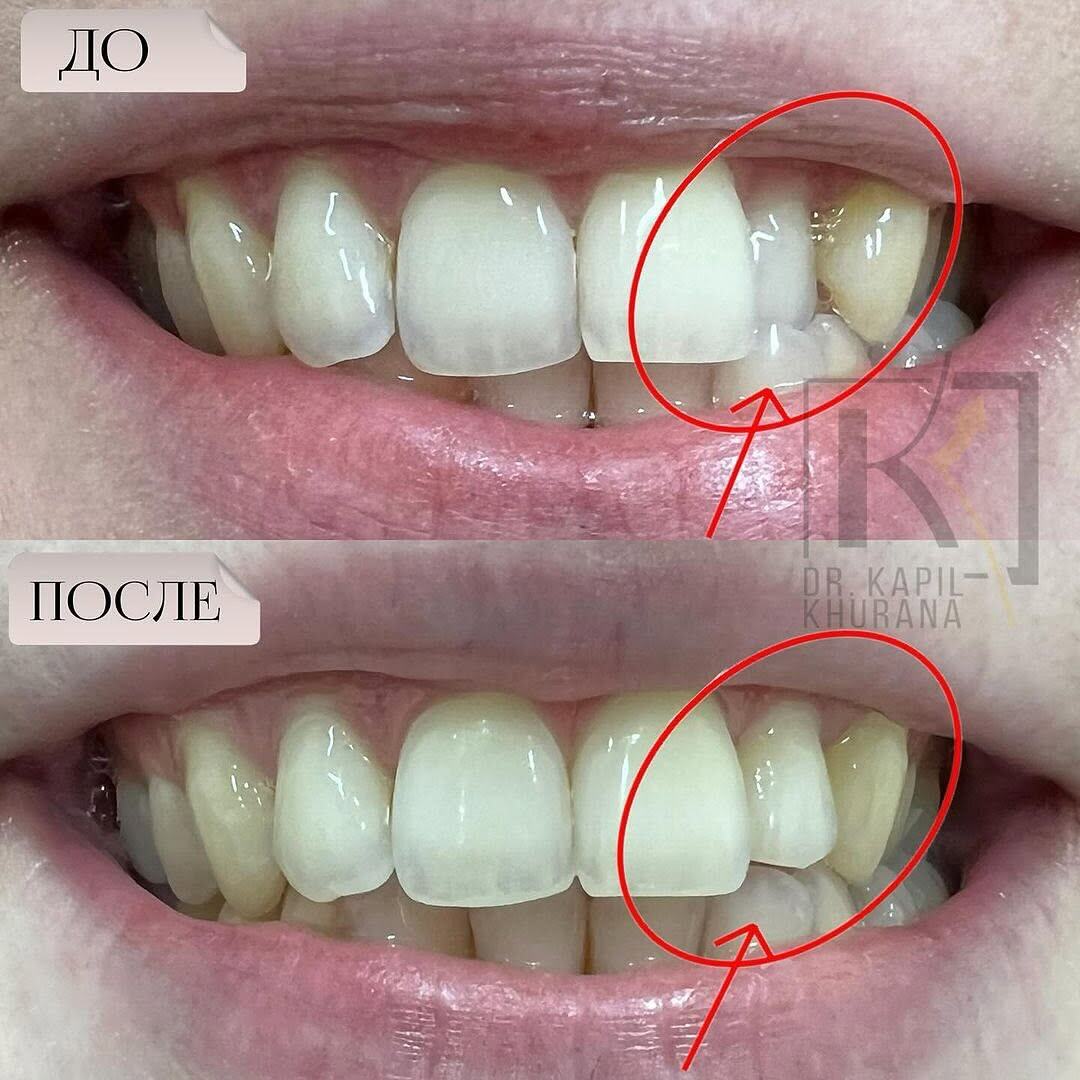 Inman элайнеры