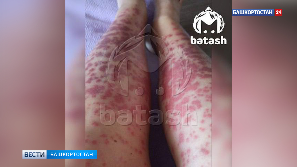    В СК начали проверку после того, как в Уфе клиентка салона лазерной эпиляции получила ожоги