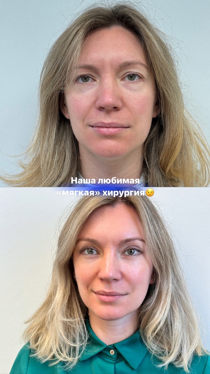 Эндоскопический лифтинг верхней трети и нижняя трансконъюктивальная блефаропластика