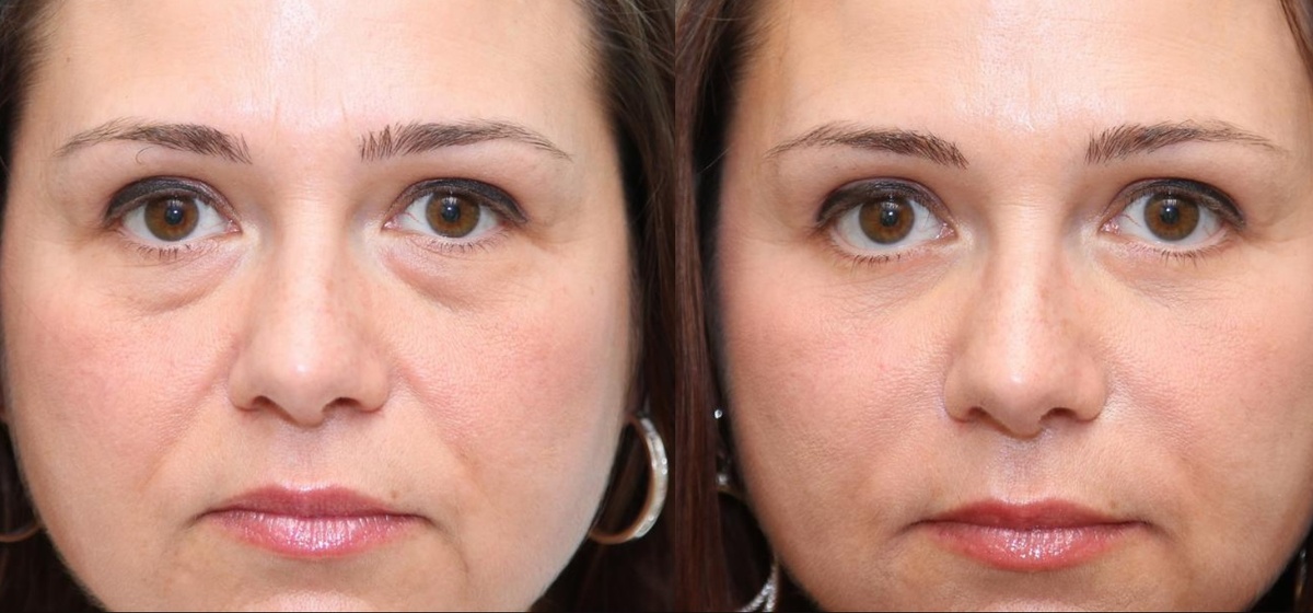 Как бороться с отёками на лице? Простые шаги к свежему и отдохнувшему виду