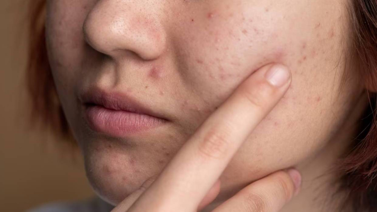 Угревая сыпь: лечение дома и с помощью специалистов