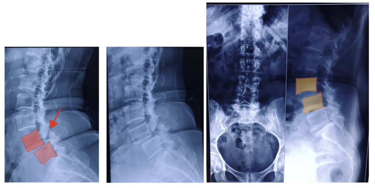 Рентгенография пациента с истмическим спондилолистезом на уровне L4-L5. 
Стрелкой указана зона перелома дужки позвонка L4