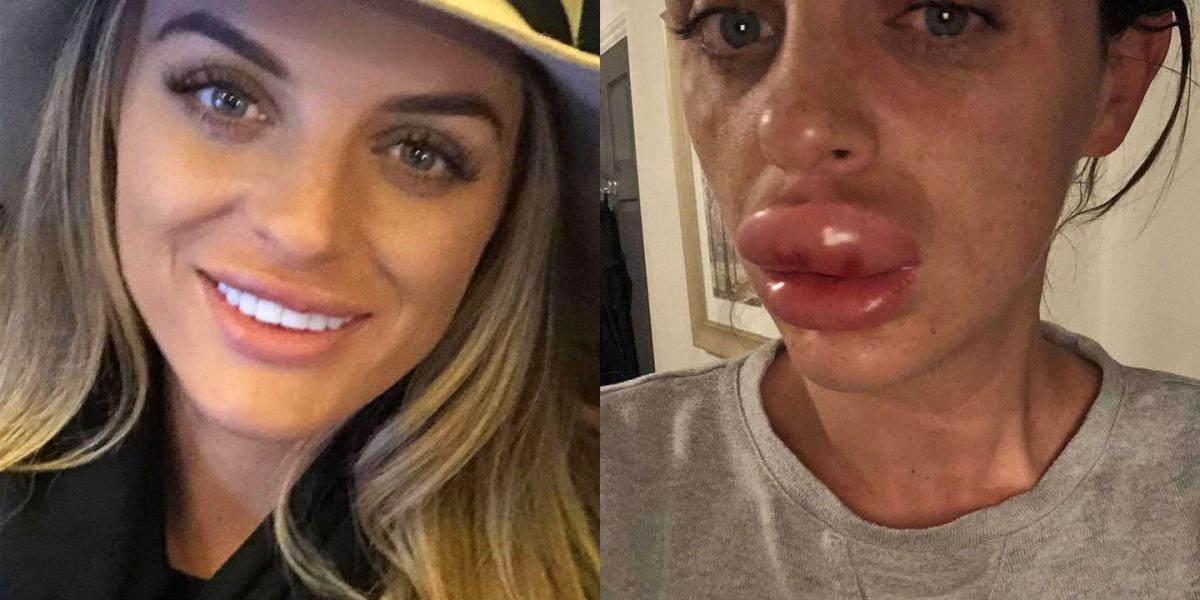 Фото: https://www.yahoo.com/lifestyle/woman-botched-fillers-made-her-223900395.html