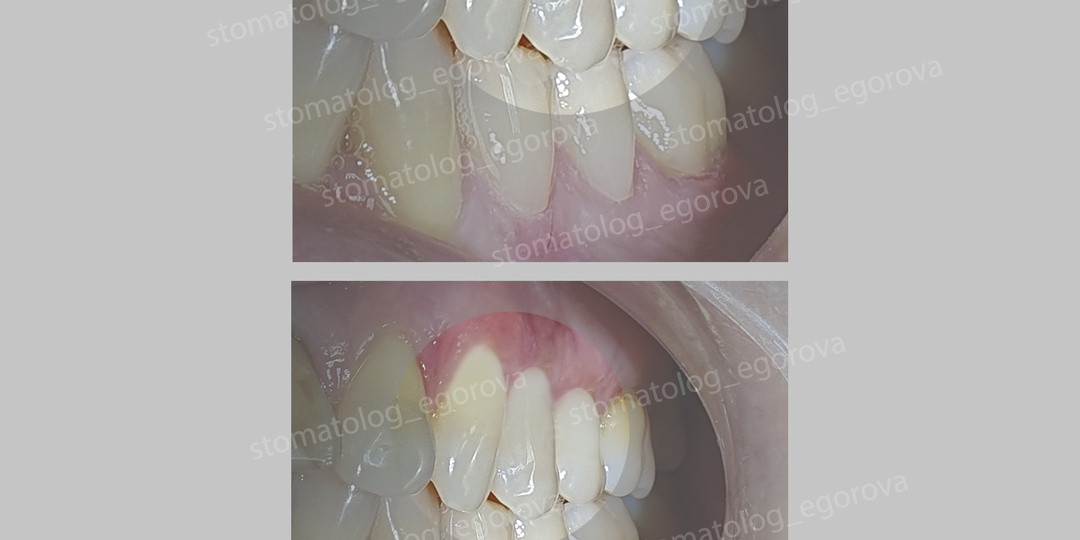 Лечение клиновидного дефекта