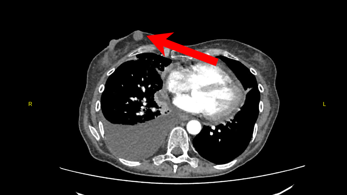 Новообразование в правой молочной железе 