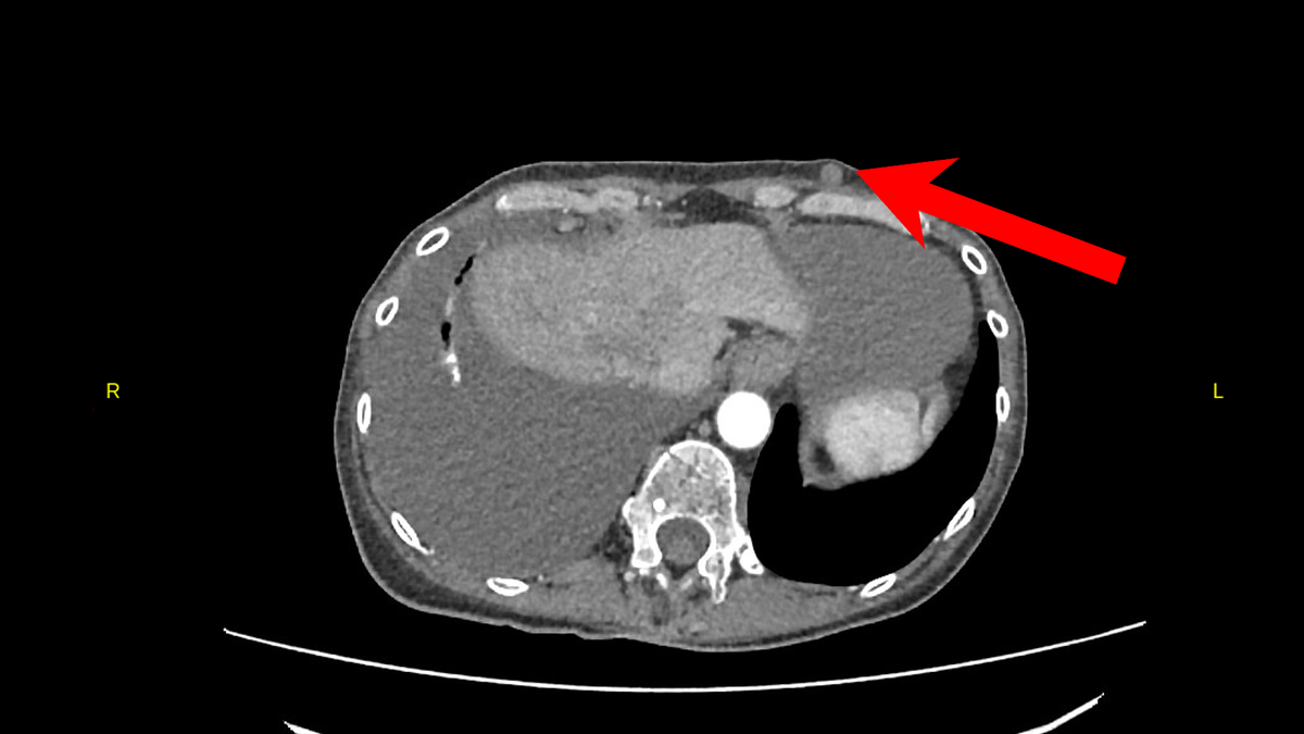 Новообразованиие в мягких тканях туловища