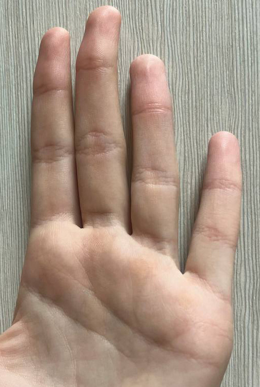 Низкая посадка мизинца