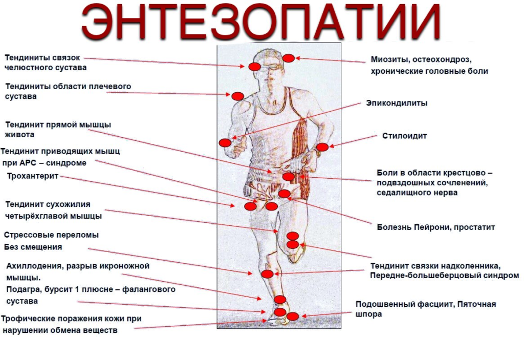Варианты энтезопатий: эентезо - название зоны прикрепления, патия - ее повреждение. 