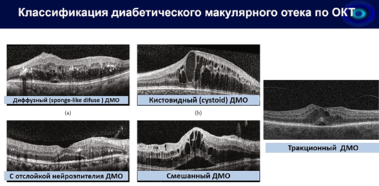 Критерии клинически значимого ДМО (ETDRS):
1. Утолщение сетчатки/твердые экссудаты в центре макулы
2. Отек в пределах 500 мкм от центра макулы
3. Зона отека ≥1 диаметра ДЗН вблизи макулы
