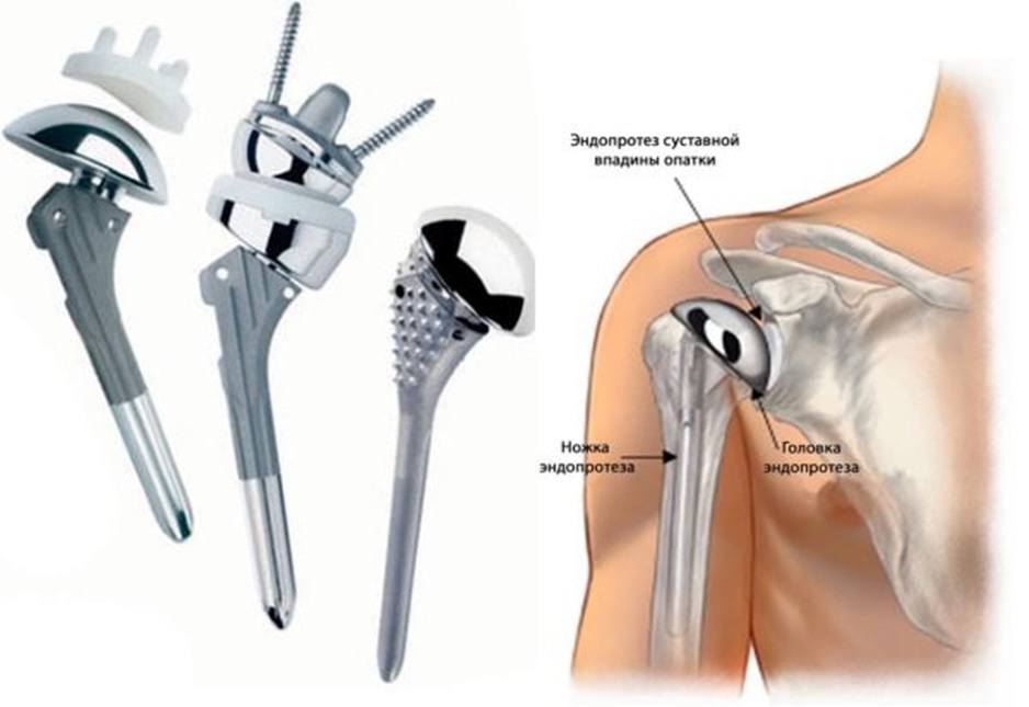 Такой эндопротез позволит человеку со сложным переломом вновь стать здоровым и активным. Фото: sun9-16.userapi.com