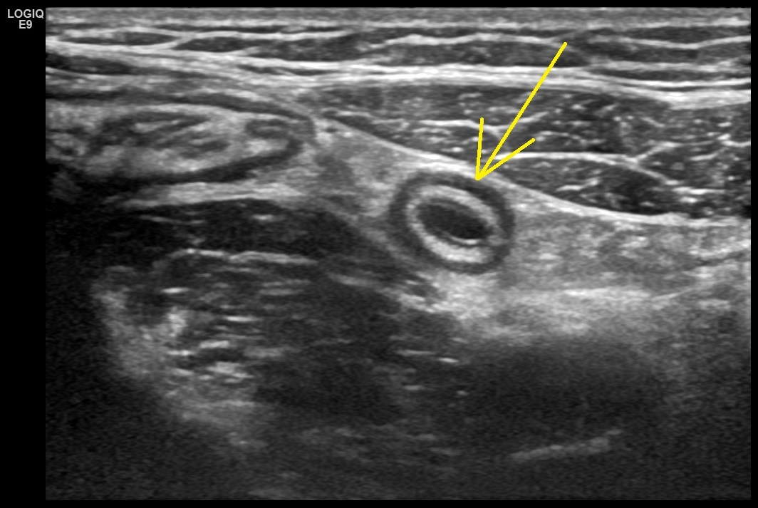 Рис. 01. Аппендикс, поперечное изображение.