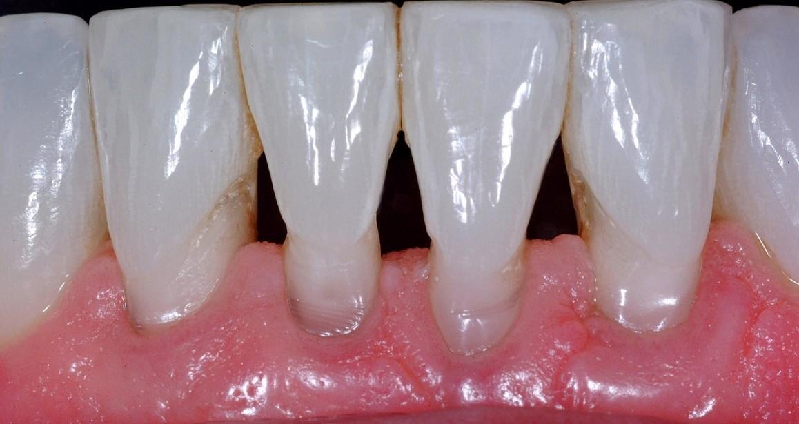 Рецессия десны 4 класса (по классификации Миллера)