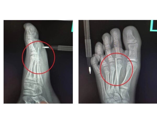 10-летний мальчик наступил на одну из иголок. Фото © Предоставлено Life.ru