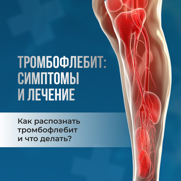 Тромбофлебит