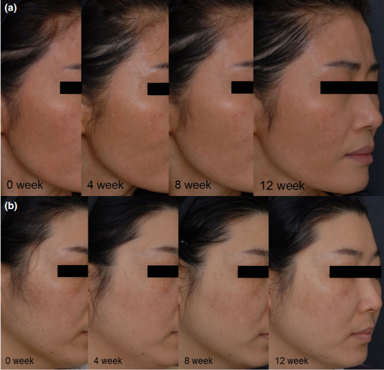 Результат работы транексамовой кислоты в том самом исследовании, проплаченным Шисейдо. Если смотреть бегло, то никаких изменений вы не заметите. Но когда начинаешь присматриваться, особенно к коллажу b, то видно, что тон височной зоны выровнялся. С 8-ой недели "точечки" стали как-то более выраженными на фото, но красноты меньше