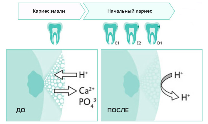 Применение метода ICON на начальном кариесе