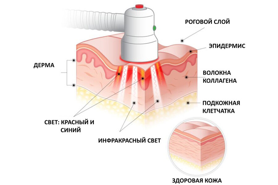 Фотодинамическая терапия (LED-терапия). Зачем проводится и как часто?