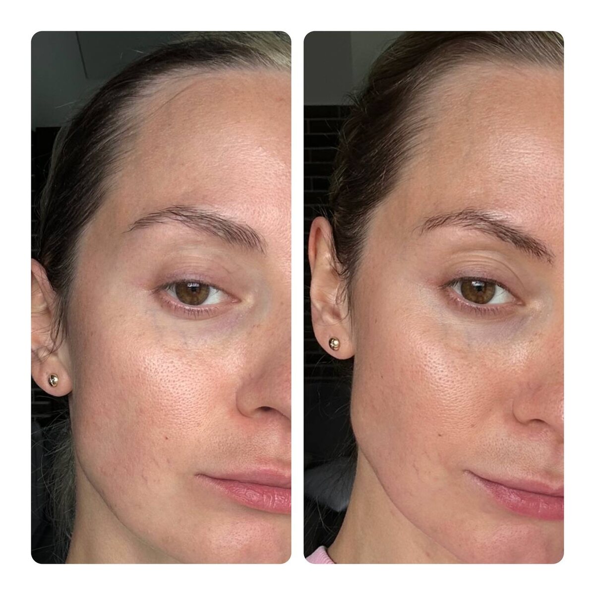 Кожа после трех недель использования travel-сет Evercell. 