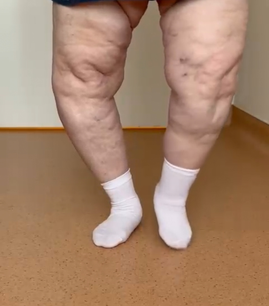 Варусная, или О-образная деформация ног