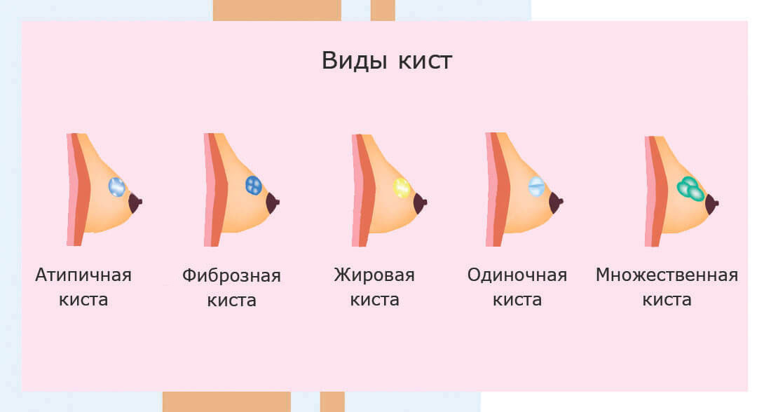 Виды кист молочной железы