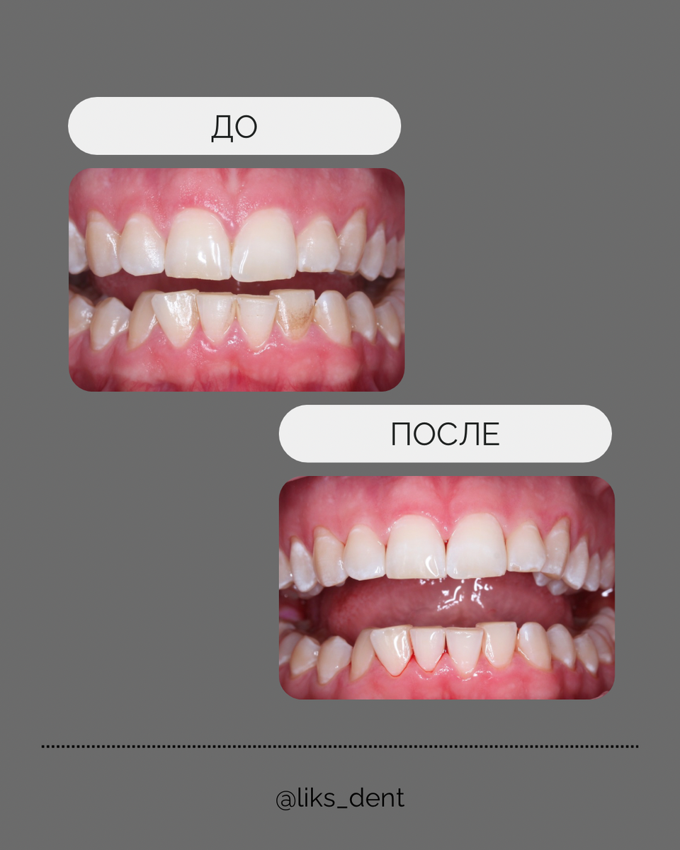 До/после проф.гигиена