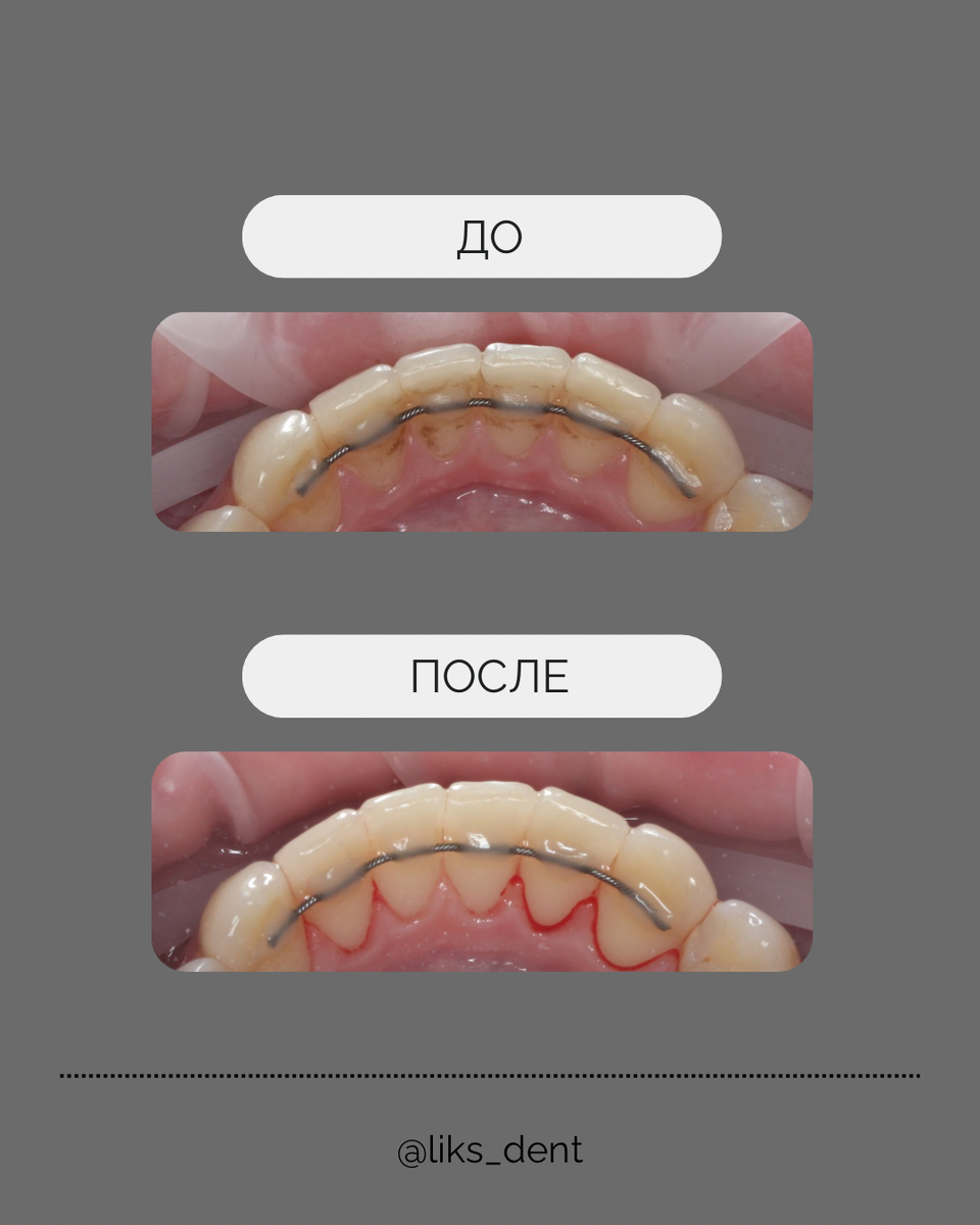 До/после проф.гигиена
