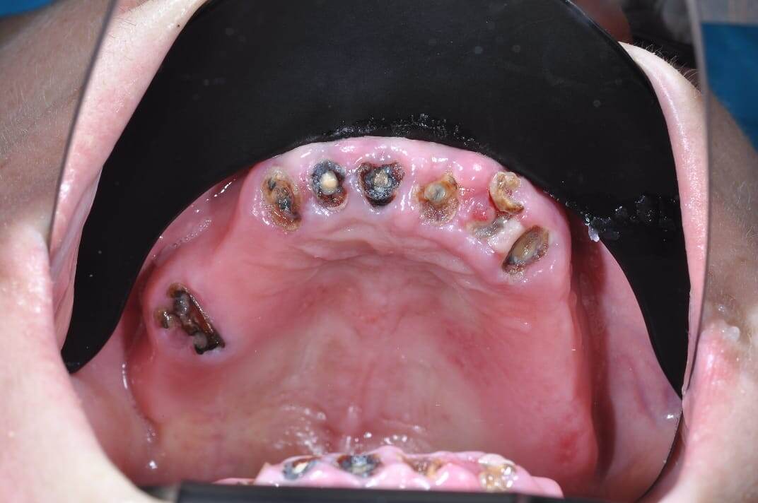 Зубы на фотографии не подлежат лечению в связи с деменерализацией твердых тканей.