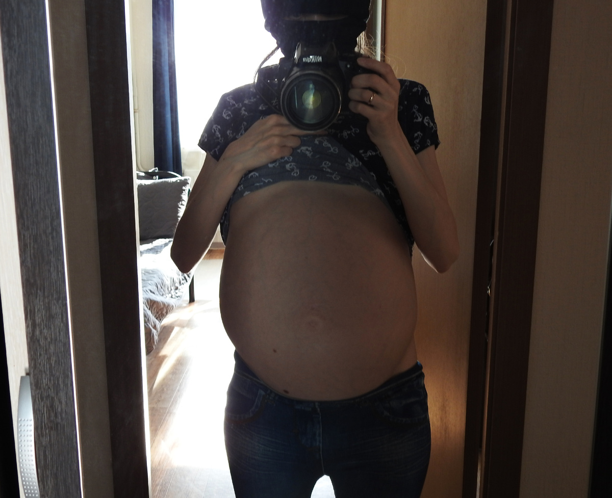 Напряженный асцит