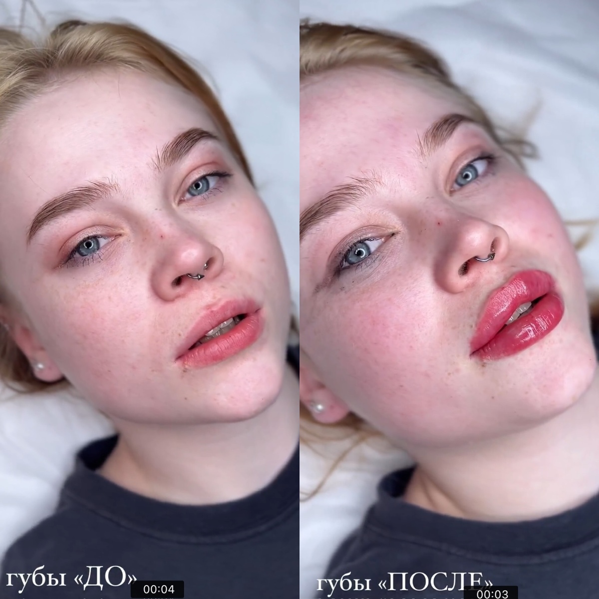 Работа Керимовой А. А. до/после контурной пластики губ филлером 𝐒𝐓𝐘𝐋𝐀𝐆𝐄 𝐌 Франция 🇫🇷