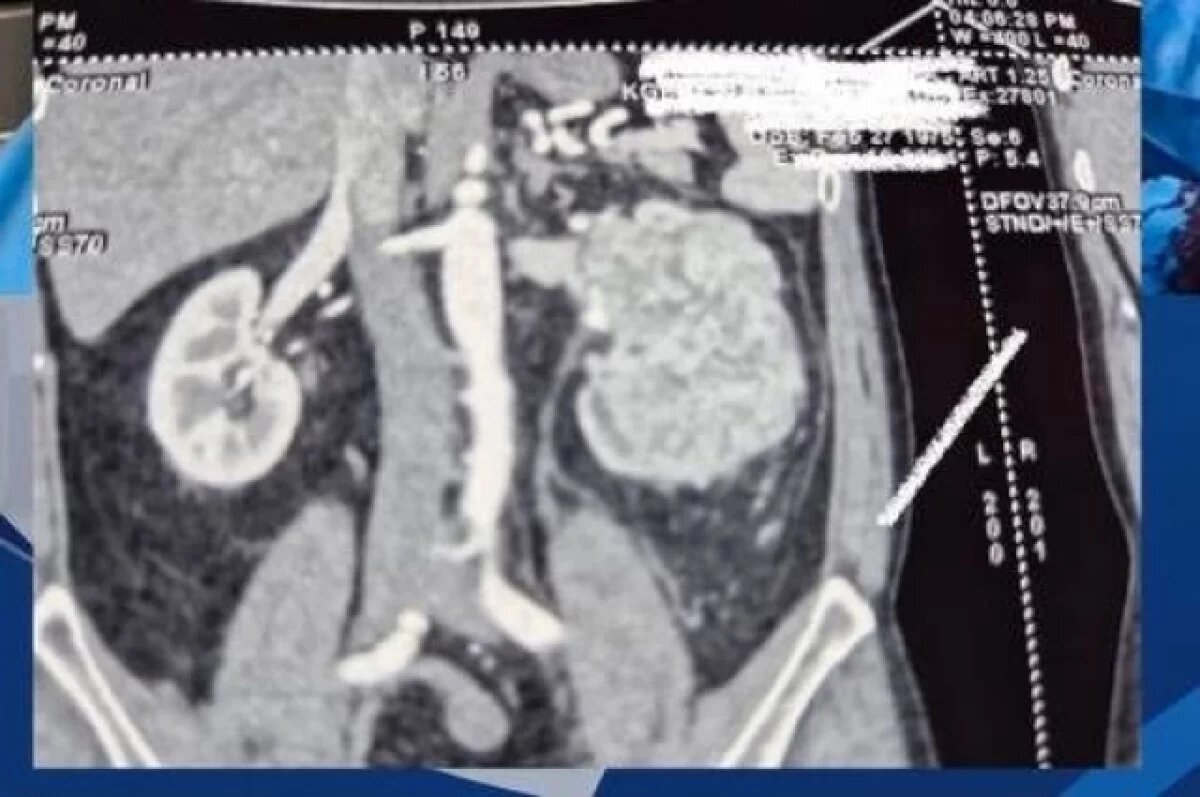    В результате врачам удалось полностью удалить опухоль вместе с почкой