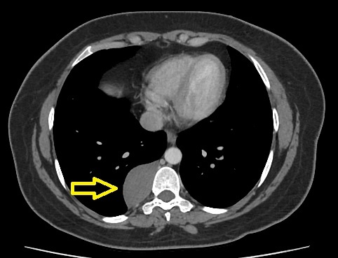 Образование заднего средостения 