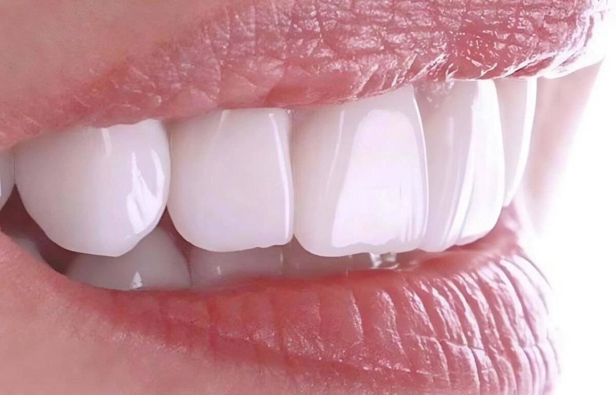 Керамические коронки E-max