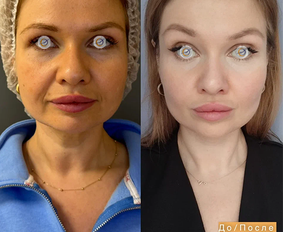 SMAS-лифтинг без скальпеля