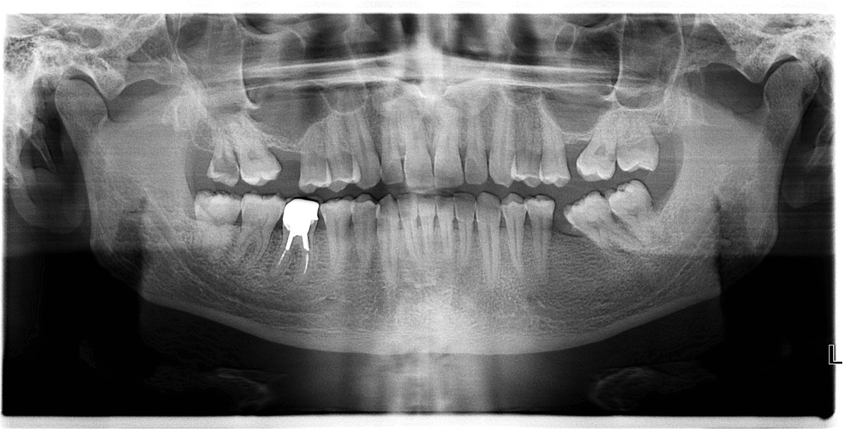 Снимок проводится до лечения.