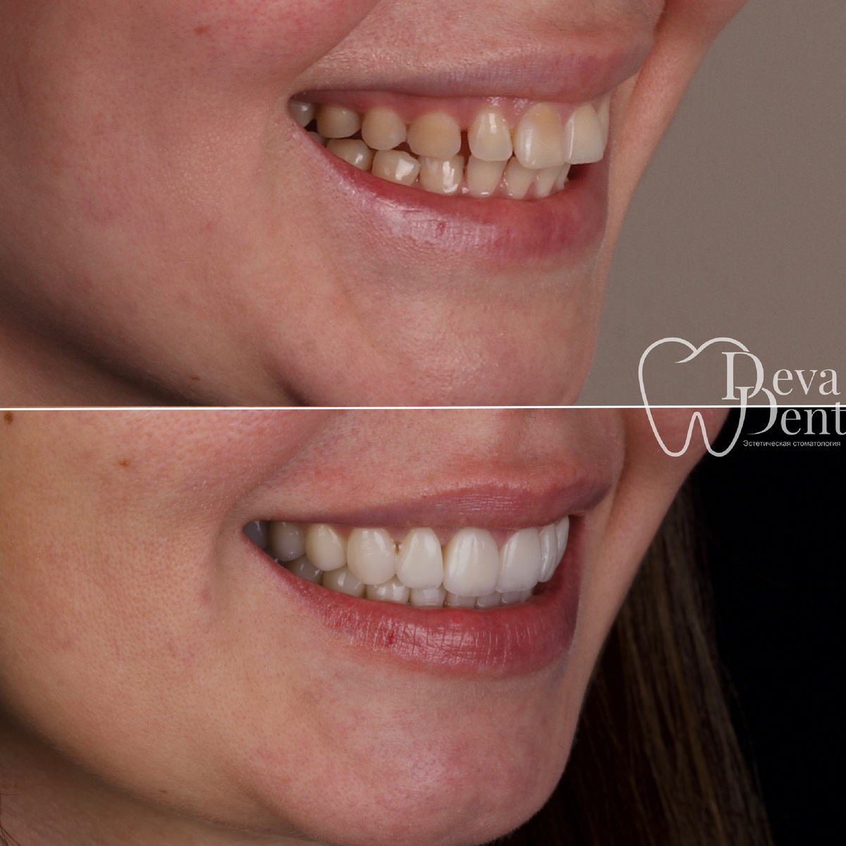 Эстетика + функциональность ❤️
✔️Лечение с помощью брекет-системы
✔️Протезирование керамическими винирами и коронками E-max