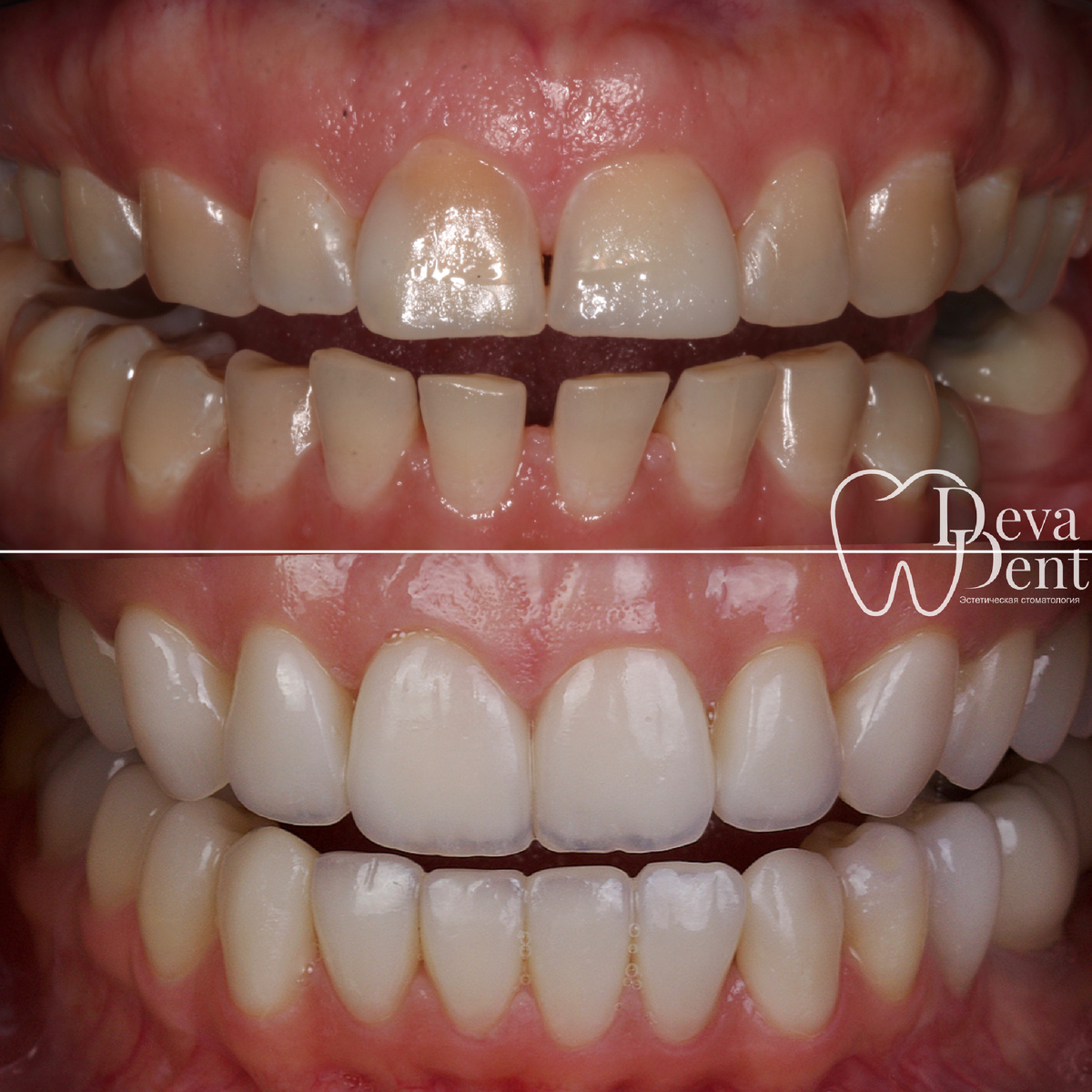 Эстетика + функциональность ❤️
✔️Лечение с помощью брекет-системы
✔️Протезирование керамическими винирами и коронками E-max
