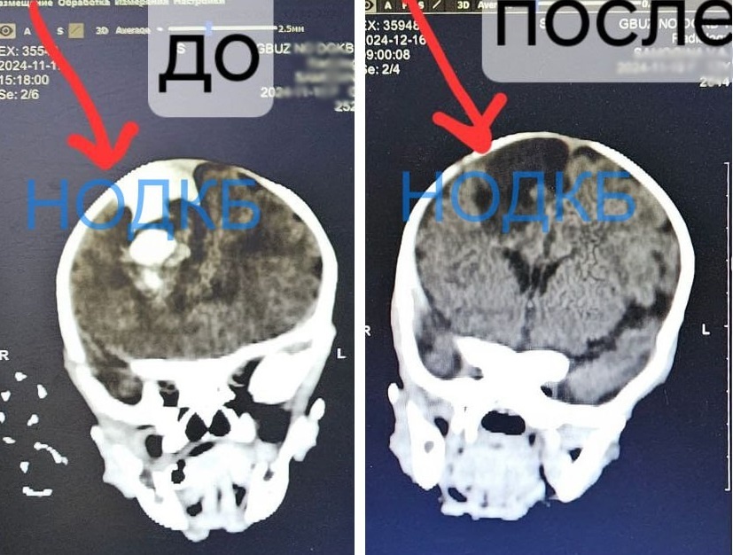    Кровоизлияние обнаружили на третьи сутки после рождения