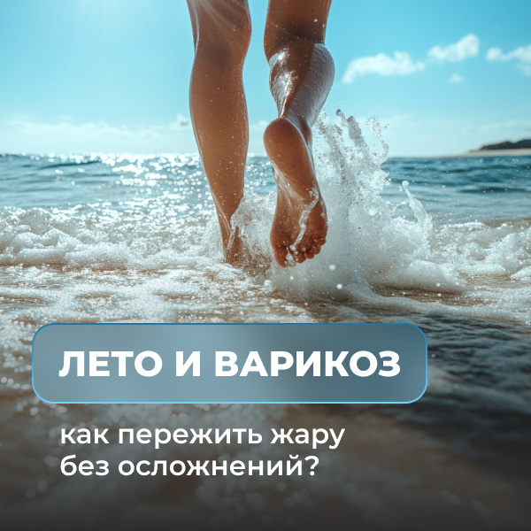 Лето и варикоз