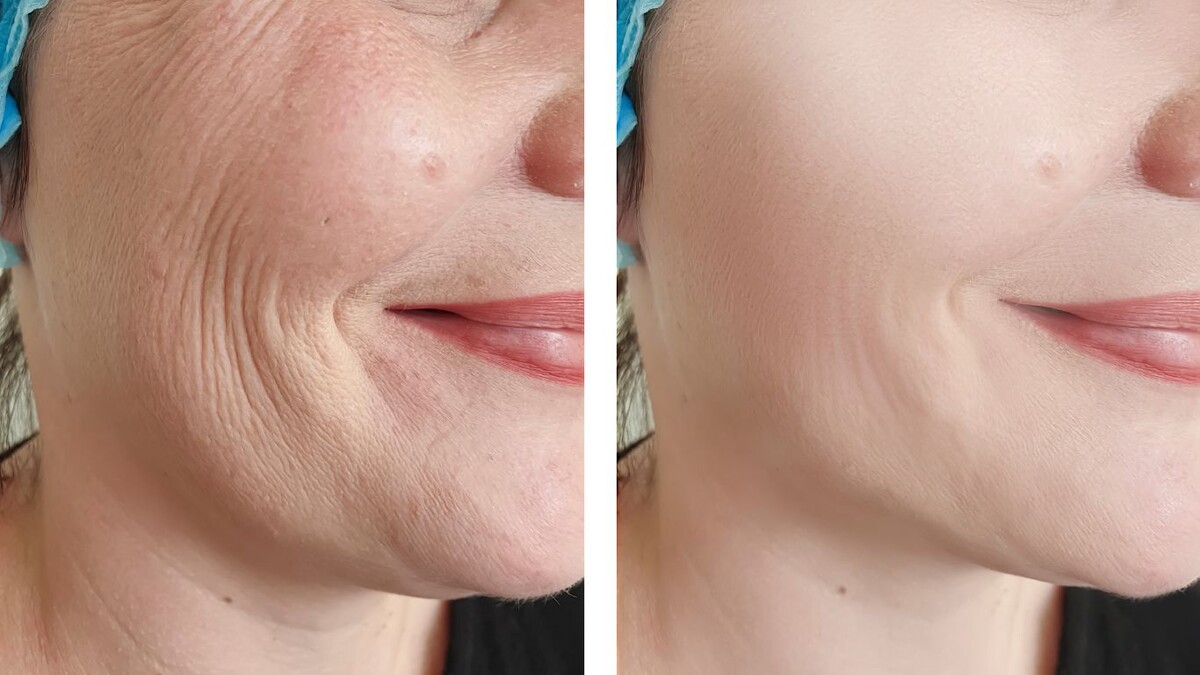 Как проходит реабилитация после SMAS-лифтинга лица: рассказывает пластический хирург