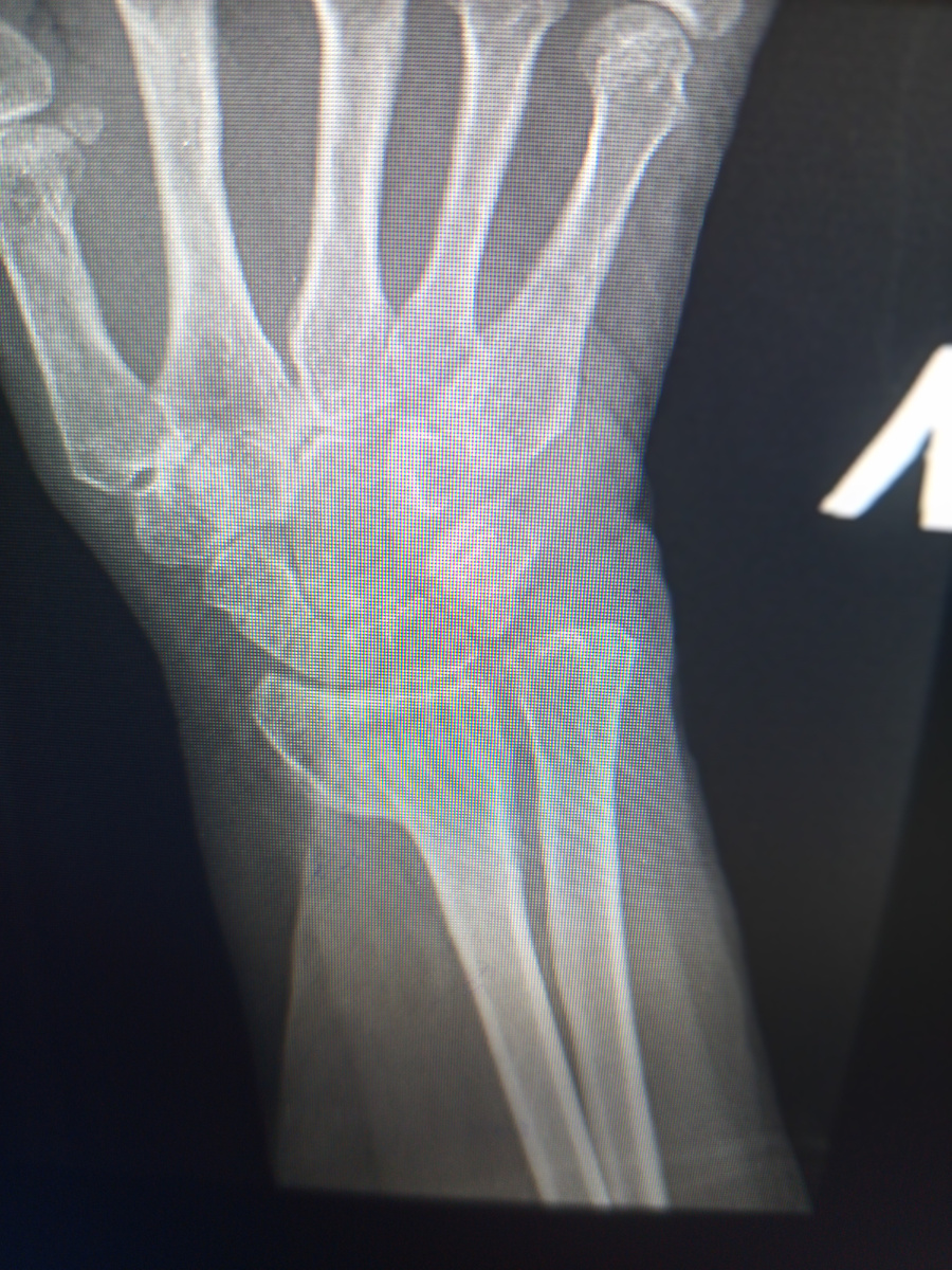 Вколоченный перелом