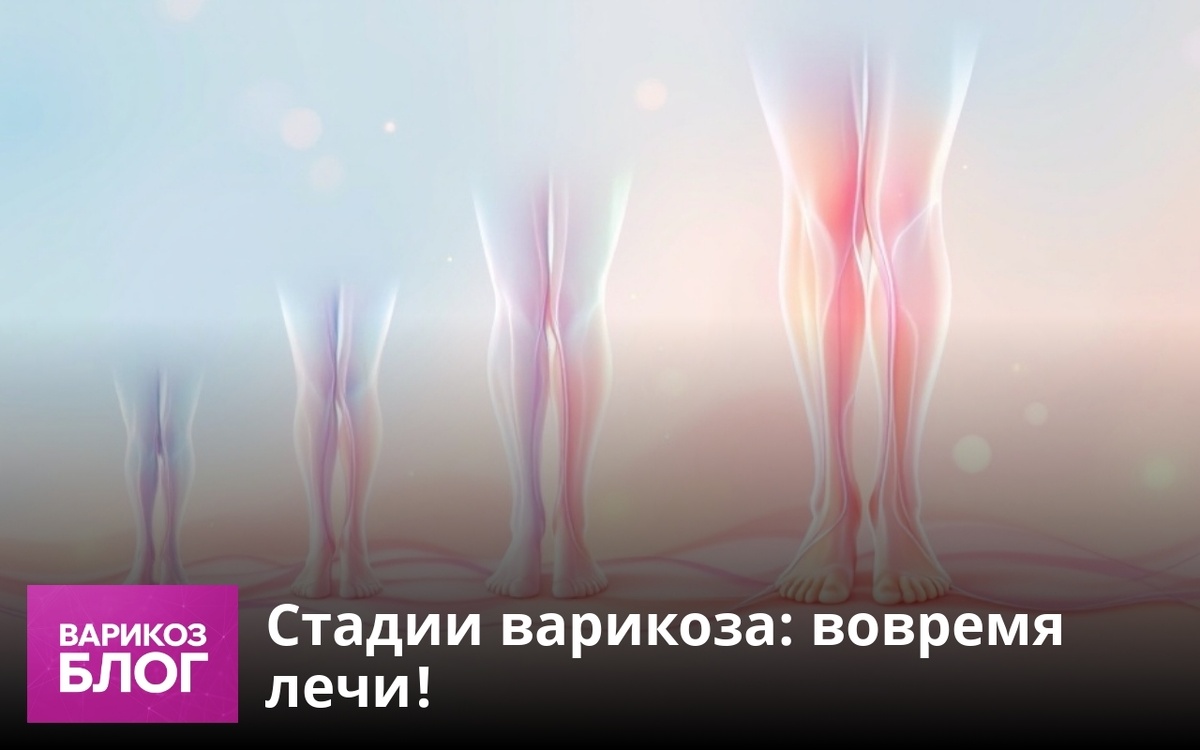    Узнайте о стадиях варикоза: распознайте симптомы и выберите эффективные методы лечения. Своевременная диагностика поможет избежать осложнений. Заботьтесь о своих венах! vrk-adm