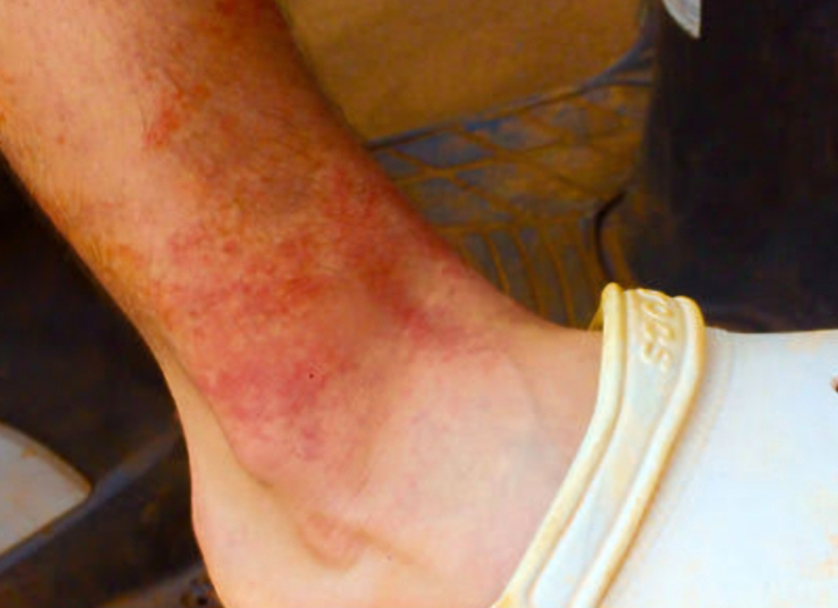 Так может выглядеть ожог после укуса медузы