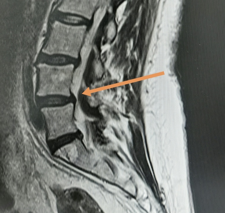 Как видно на изображении, диск выступает незначительно, а стеноз канала обусловлен гипертрофией жёлтых связок. Темная масса под стрелкой.