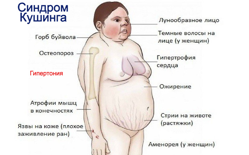 Синдром Кушинга