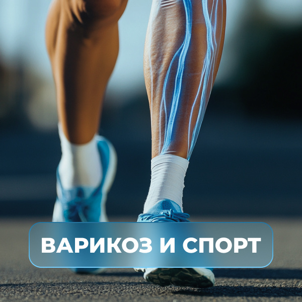 Варикоз и спорт