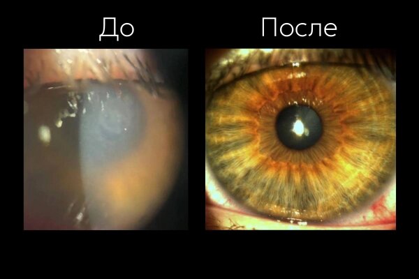 Глаз подростка во время и после трёхмесячного ношения линз. Фото © Минздрав Московской области