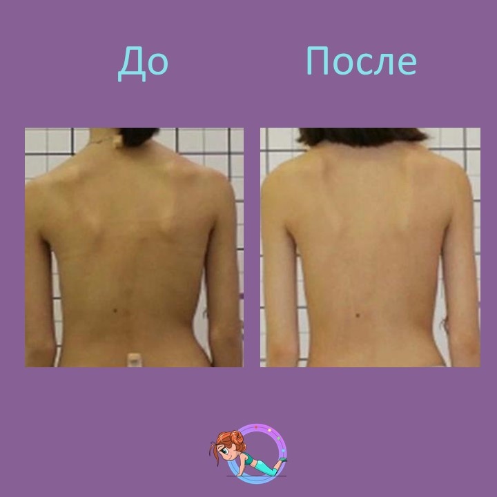 
Пациентка В. 2007 г.р. обратилась на приём к врачу ортопеду к.м.н. Громову И.С. с жалобами на деформацию позвоночника.🩺
При осмотре поставлен диагноз: юношеский идиопатический сколиоз третей степени.                                                                         На сегодняшний момент в корсете Шено угол деформации уменьшен с 28 до 7 градусов👏 
Коррекция в корсете 80 %🤩🏆 Так же получен хороший косметический результат❤️‍🔥

