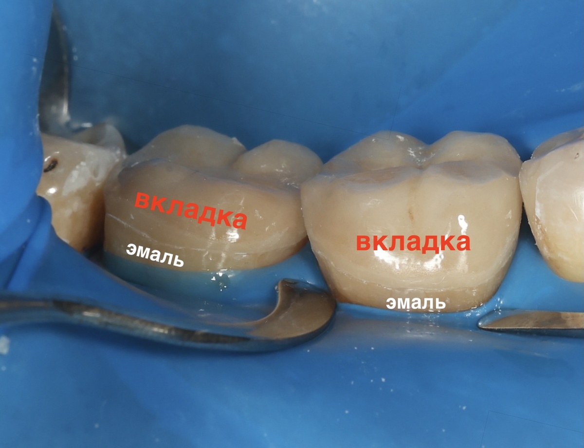 Ортопедическия вкладки