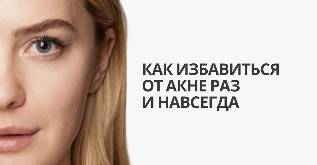 КАК ИЗБАВИТЬСЯ ОТ АКНЕ РАЗ И НАВСЕГДА