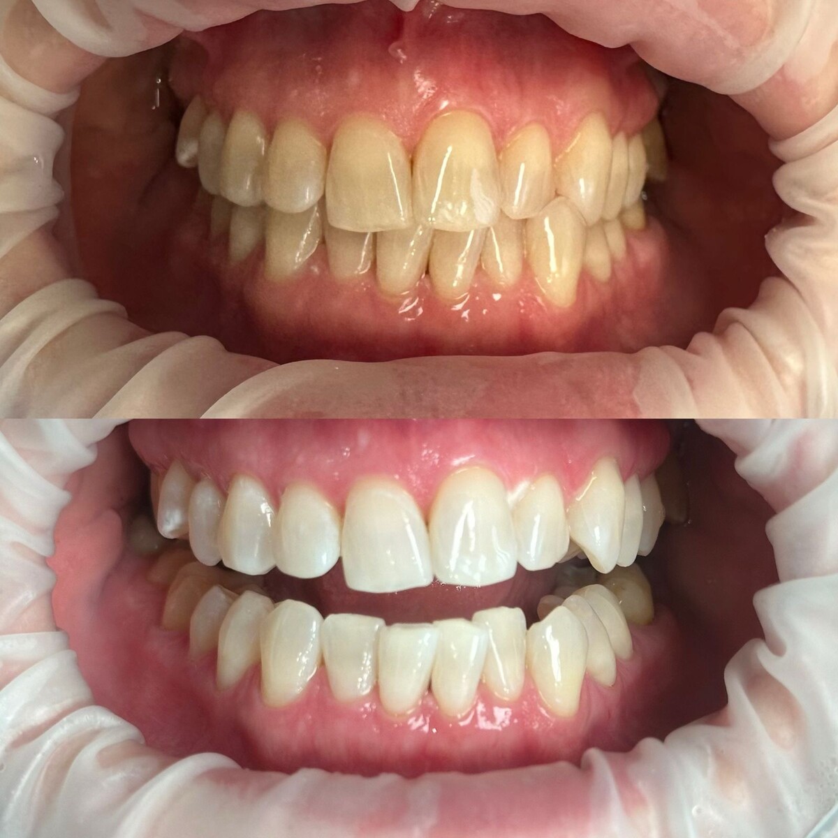 До и после процедуры отбеливания.